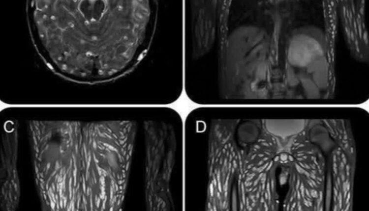 ‏می‌دونید این نقاط متعدد سفید در این تصویر MRI چی هستن؟
